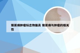 银屑病肿瘤标志物偏高 银屑病与肿瘤的相关性