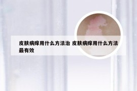 皮肤病痒用什么方法治 皮肤病痒用什么方法最有效