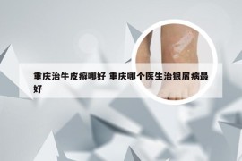 重庆治牛皮癣哪好 重庆哪个医生治银屑病最好