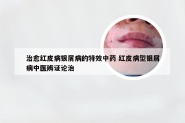 治愈红皮病银屑病的特效中药 红皮病型银屑病中医辨证论治