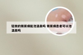 轻微的银屑病能泡温泉吗 银屑病患者可以泡温泉吗