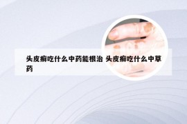 头皮癣吃什么中药能根治 头皮癣吃什么中草药