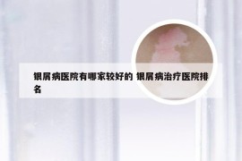 银屑病医院有哪家较好的 银屑病治疗医院排名