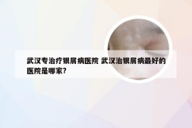 武汉专治疗银屑病医院 武汉治银屑病最好的医院是哪家?