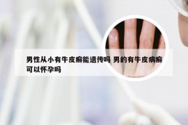 男性从小有牛皮癣能遗传吗 男的有牛皮病癣可以怀孕吗