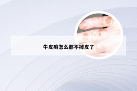 牛皮癣怎么都不掉皮了