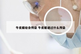 牛皮廨给会传染 牛皮廨通过什么传染