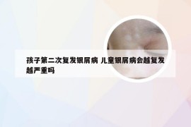 孩子第二次复发银屑病 儿童银屑病会越复发越严重吗