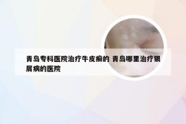 青岛专科医院治疗牛皮癣的 青岛哪里治疗银屑病的医院