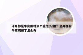 浑身都是牛皮癣特别严重怎么治疗 全身都有牛皮病癣了怎么办