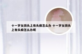 十一岁女孩头上有头癣怎么办 十一岁女孩头上有头癣怎么办呢