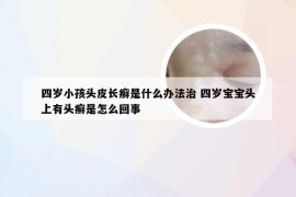 四岁小孩头皮长癣是什么办法治 四岁宝宝头上有头癣是怎么回事