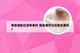 银屑病能吃清明果吗 银屑病可以吃银杏果吗?