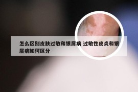 怎么区别皮肤过敏和银屑病 过敏性皮炎和银屑病如何区分