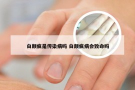 白颠疯是传染病吗 白颠疯病会致命吗