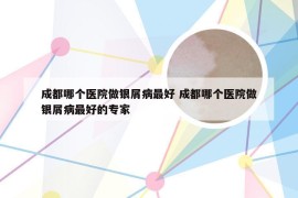 成都哪个医院做银屑病最好 成都哪个医院做银屑病最好的专家