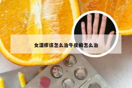 女湿疹该怎么治牛皮癣怎么治