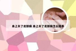 身上长了皮肤癣 身上长了皮肤癣怎么回事