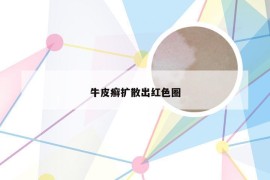 牛皮癣扩散出红色圈