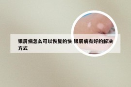 银屑病怎么可以恢复的快 银屑病有好的解决方式