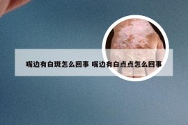 嘴边有白斑怎么回事 嘴边有白点点怎么回事