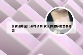 皮肤湿疹是什么样子的 女人得湿疹的主要原因