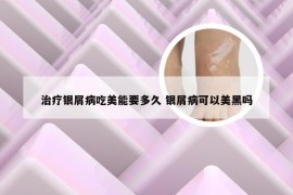 治疗银屑病吃美能要多久 银屑病可以美黑吗