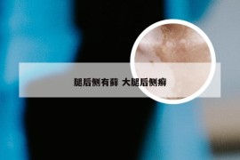 腿后侧有藓 大腿后侧癣