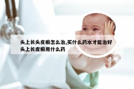 头上长头皮癣怎么治,买什么药水才能治好 头上长皮癣用什么药