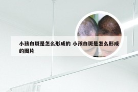 小孩白斑是怎么形成的 小孩白斑是怎么形成的图片