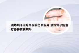 油炸蝎子治疗牛皮癣怎么服用 油炸蝎子能治疗各种皮肤病吗