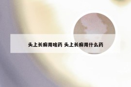 头上长癣用啥药 头上长癣用什么药