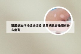 银屑病治疗将烟点燃吸 银屑病患者抽烟有什么危害