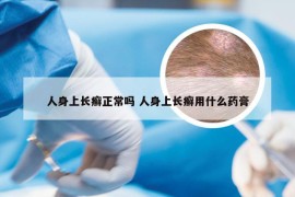 人身上长癣正常吗 人身上长癣用什么药膏