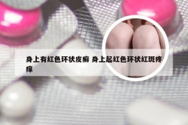 身上有红色环状皮癣 身上起红色环状红斑疼痒