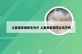 儿童银屑病照完光疗 儿童银屑病可以光疗吗