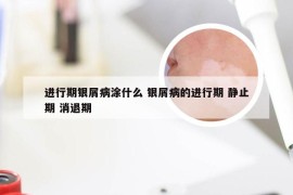 进行期银屑病涂什么 银屑病的进行期 静止期 消退期