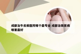 成都治牛皮癣医院哪个最专业 成都治银屑病哪里最好