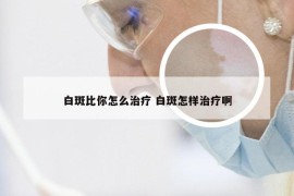 白斑比你怎么治疗 白斑怎样治疗啊