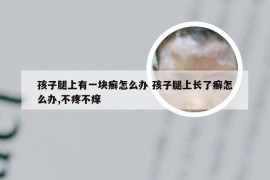 孩子腿上有一块癣怎么办 孩子腿上长了癣怎么办,不疼不痒