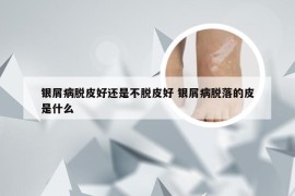 银屑病脱皮好还是不脱皮好 银屑病脱落的皮是什么