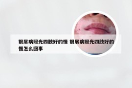 银屑病照光四肢好的慢 银屑病照光四肢好的慢怎么回事