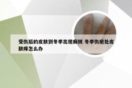 受伤后的皮肤到冬季出现癣斑 冬季伤疤处皮肤痒怎么办