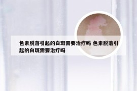 色素脱落引起的白斑需要治疗吗 色素脱落引起的白斑需要治疗吗