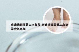 点滴状银屑第二次复发 点滴状银屑第二次复发会怎么样