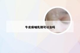 牛皮癣哺乳期可以治吗