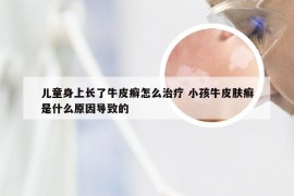 儿童身上长了牛皮癣怎么治疗 小孩牛皮肤癣是什么原因导致的