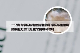 一只脚有掌跖脓泡病能治愈吗 掌跖脓疱病脚底脓疱无法行走,把它挑破可以吗