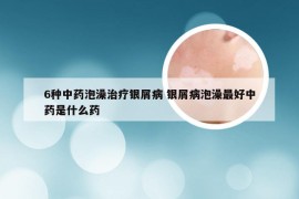 6种中药泡澡治疗银屑病 银屑病泡澡最好中药是什么药