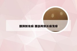 腰俩侧有癣 腰部两侧长癣发痒